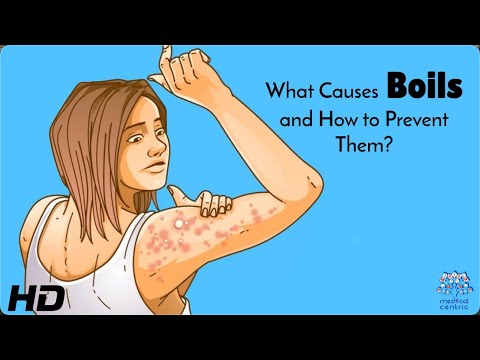 What Really Causes Boils and How You Can Prevent Them