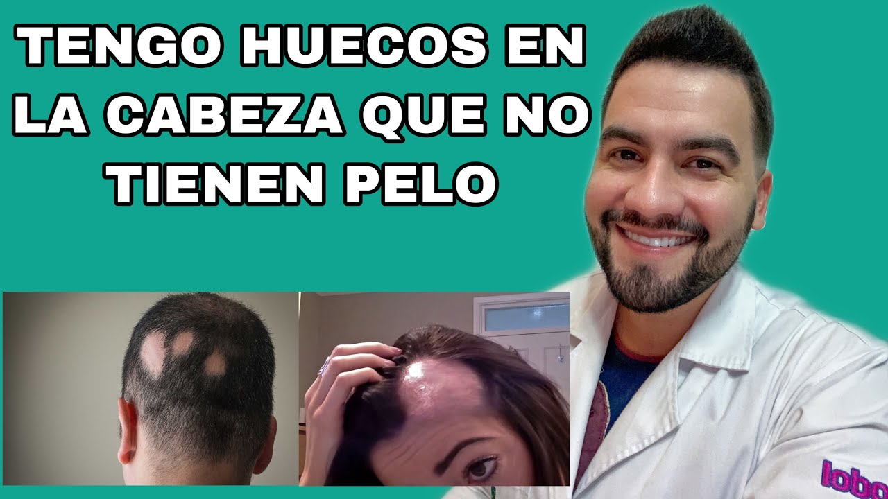 Porque se me hacen huecos sin pelo en la cabeza / Alopecia Areata / Alopecia | DR. DAVID CAMPOS