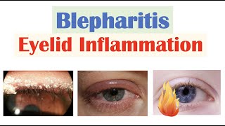 Blepharitis (Eyelid Inflammation) | Causes, Risk Factors, Signs & Symptoms, Diagnosis, Treatment