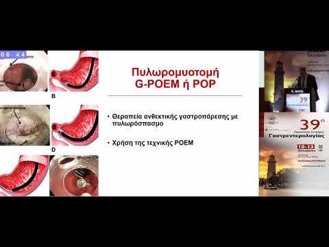 Δελής Κ. - Από την POEM στις αναδυόμενες νέες ενδοσκοπικές εφαρμογές (G-POEM, STER, Z-POEM)