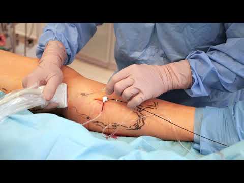 Leczenie i usuwanie żylaków falami radiowymi EVRF - Kriocentrum