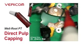 Well-Root PT Direct Pulp Capping