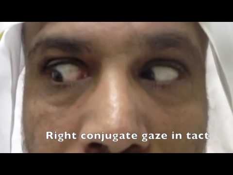 Reel-Example: Parinaud's Syndrome 1