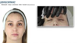 Marcação para aplicação de Toxina Botulínica