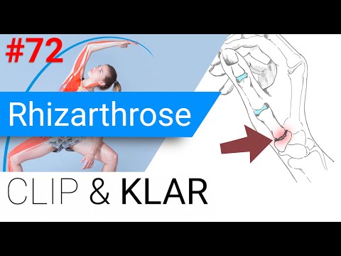 Rhizarthrose erklärt - Daumen-Rodeo