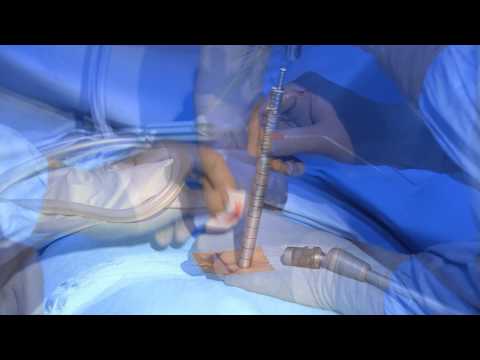 Zervikale Osteochondrose und erhöhte Rezept von Gelenken Dimexidum