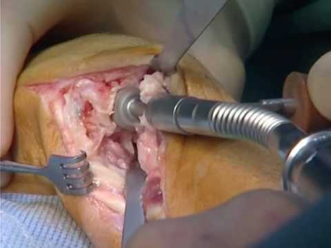 UHP spherical by KLS Martin