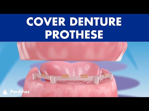 Cover-Denture-Prothese ©