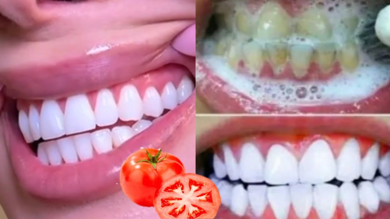 لن يخبروك أحد بالسر الفعال لتبييض الاسنان وإزالة الإصفرار في ثواني 💯