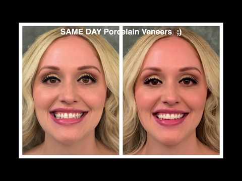 download lagu mp3 mp4 Teeth Whitening For Crowns And Veneers, download lagu Teeth Whitening For Crowns And Veneers gratis, unduh video klip Teeth Whitening For Crowns And Veneers