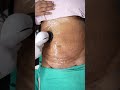 Abdomen Liposuction Result RF Session Shorts