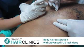 Body Hair Restoration with Advanced FUE _ Dr.Anastasios Vekris