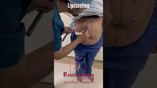liposuction  body contouring  Dr Mudassir Mahboob-