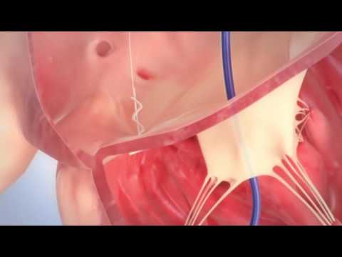 Trialign Tricuspid Valve Repair Animation