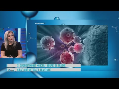 Hipokrati- 5 shenjat që paralajmërojnë një kancer në zorrën e trashë