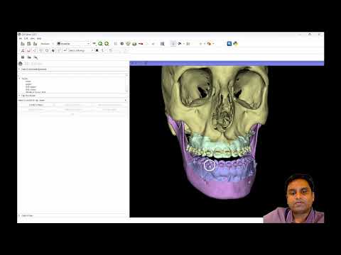 Digital Orthognathic Planning with Free & Open-Source 3D Slicer