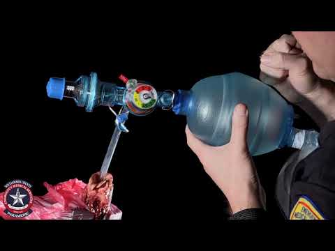 PEEP (Positive End Expiratory Pressure