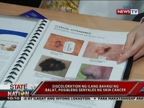 Mycosis ng kuko at paggamot forum Aspirin para sa kuko halamang-singaw forum