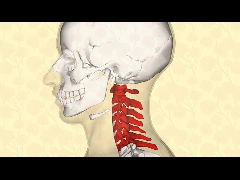 Tratamiento de dispositivo articulaciones ALMAG Tipos de lesión cervical de la columna vertebral