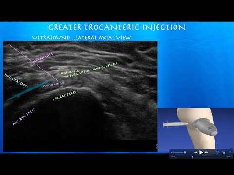 Ultrasound Guided Hip Greater Trochanteric Bursa Injection