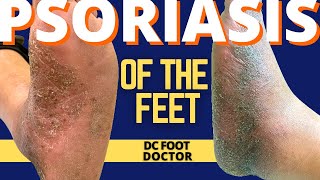 Psoriasis and the Feet, Part 2: Treating Pustular Psoriasis of the Skin