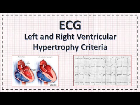 Left and Right Ventricular Hypertrophy ECG criteria | LVH | RVH | ECG | Simplified.