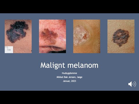 Malignt melanom - Hudsygdomme