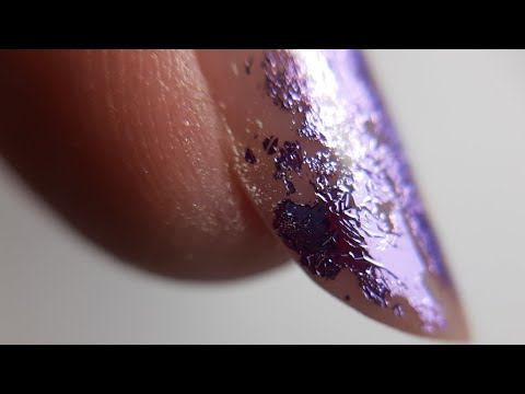 Îndepărtarea unghiei fungice cu laser