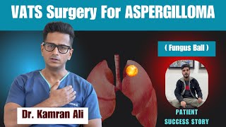 Aspergilloma Surgery - Success Story || Dr Kamran Ali