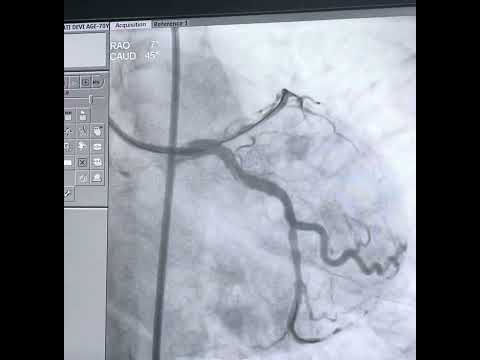Case 10:- LAD cto angioplasty with antegrade wire technique