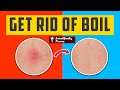 How To Get Rid Of A Boil The Right Way Scientifically Proven