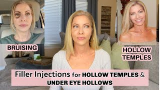 Temple & Under Eye Filler | Bruising and Lumps After Filler | What You Shoud Know | Look Younger!