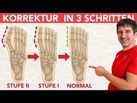 Get rid of hallux valgus - 3 simple exercises to relieve pain and crooked toes! 👣