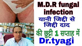 दाद खाज की चाहे जितनी दवाई खाई हो या लगाई हो यह है पक्का इलाज