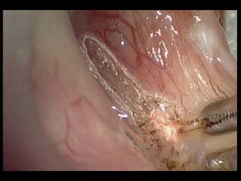 MCO 25plus – Micro Point scanner cordectomy