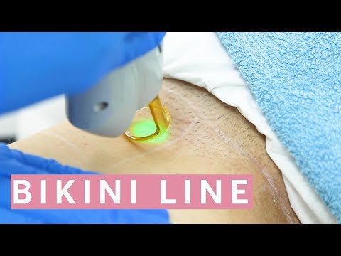 Laser Hair Removal Bikini: THIS is how it works