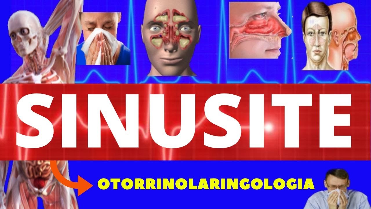 SINUSITE (CAUSAS, SINTOMAS, DIAGNÓSTICO E TRATAMENTO) - OTORRINOLARINGOLOGIA