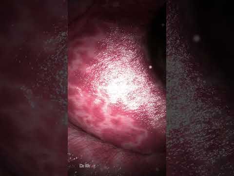 Colon Polypectomy (Polyp Removal)