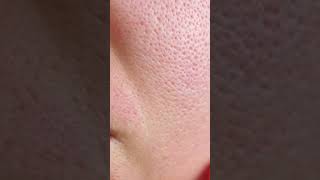 Best Serum For Acne & open pores | Subscribe for more