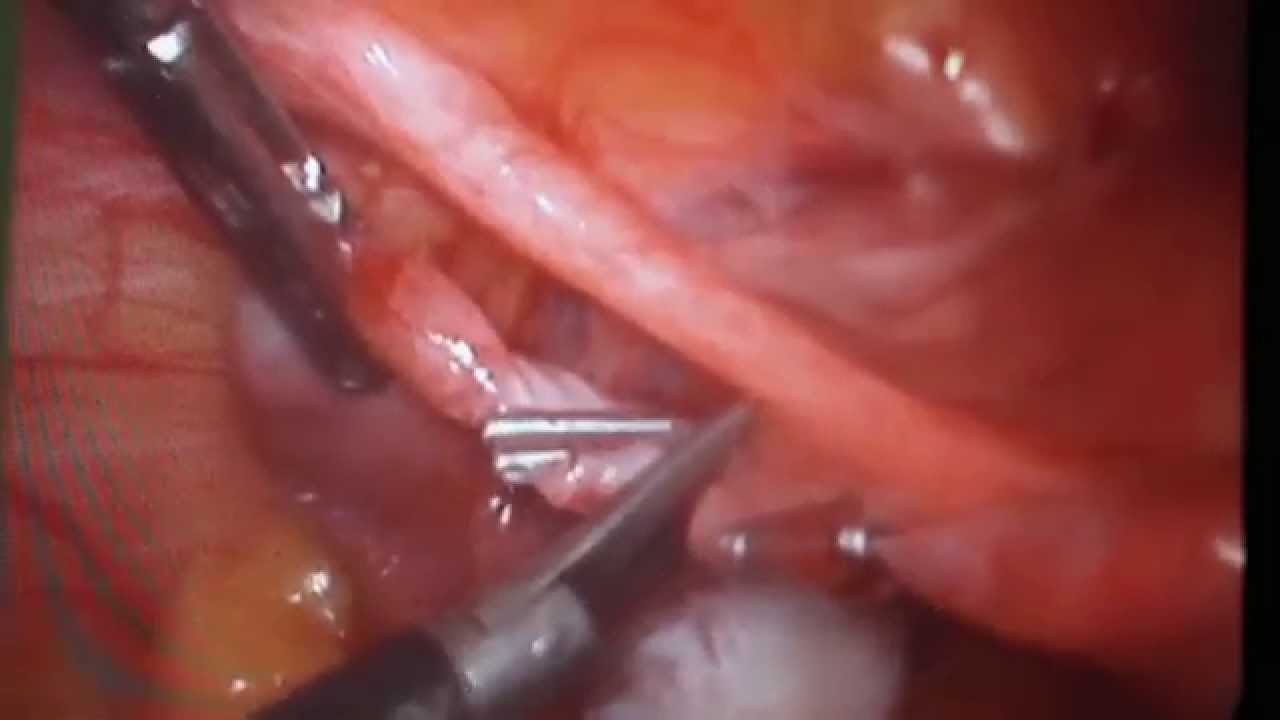 Laqueadura tubaria por video / Tubal ligation by video