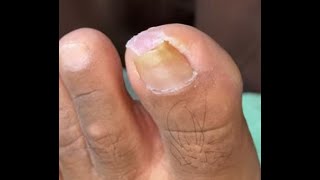 Ep_8171 Ingrown toenail removal 👣 เล็บหนูเสียครึ่งนึง 😄 (clip from Thailand)