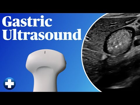 Gastric Ultrasound (Gastric POCUS)