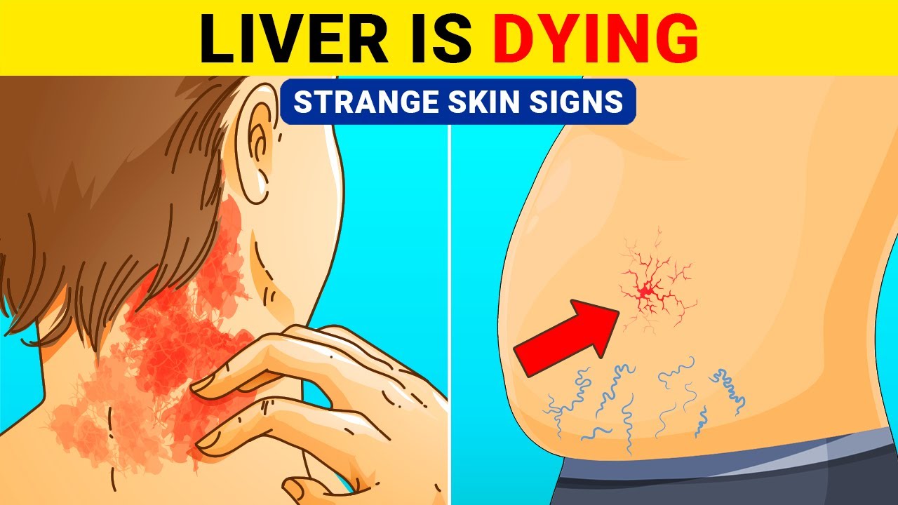 8 Strange Skin Signs Indicating Your Liver Is Damaged