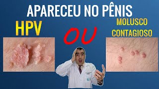 Diferenças entre HPV e MOLUSCO CONTAGIOSO no pênis