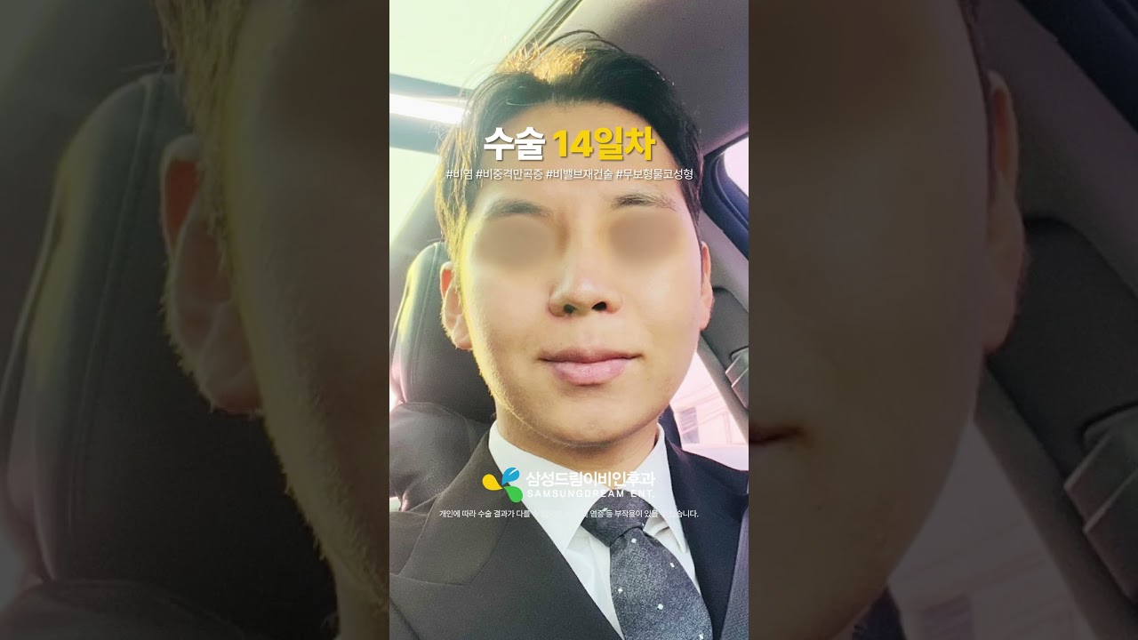 남자 무보형물 코성형 한 달 후기🤞 #shorts #비염수술 #비중격만곡증수술 #무보형물 #남자코성형 #코성형브이로그 #코성형후기 #코성형전후 #비염 #비중격 #무보형물코성형