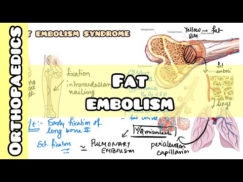 Fat Embolism Syndrome simplified for USMLE, NCLEX, NEET PG, INICET, NORCET