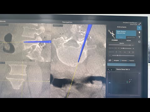 Tandem spine stenosis : can two spine a surgeries can be done same sitting| Dr. Ajay Kothari