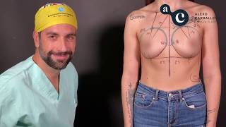 Aumento de pecho con prótesis redondas Motiva por el Dr. Alexo Carballeira