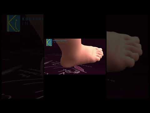 How to treat Club Foot in Babies