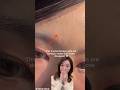 How Korean Girls Remove Acne Tiny Pimples Whiteheads Shorts